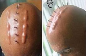 skin implants on the skull
